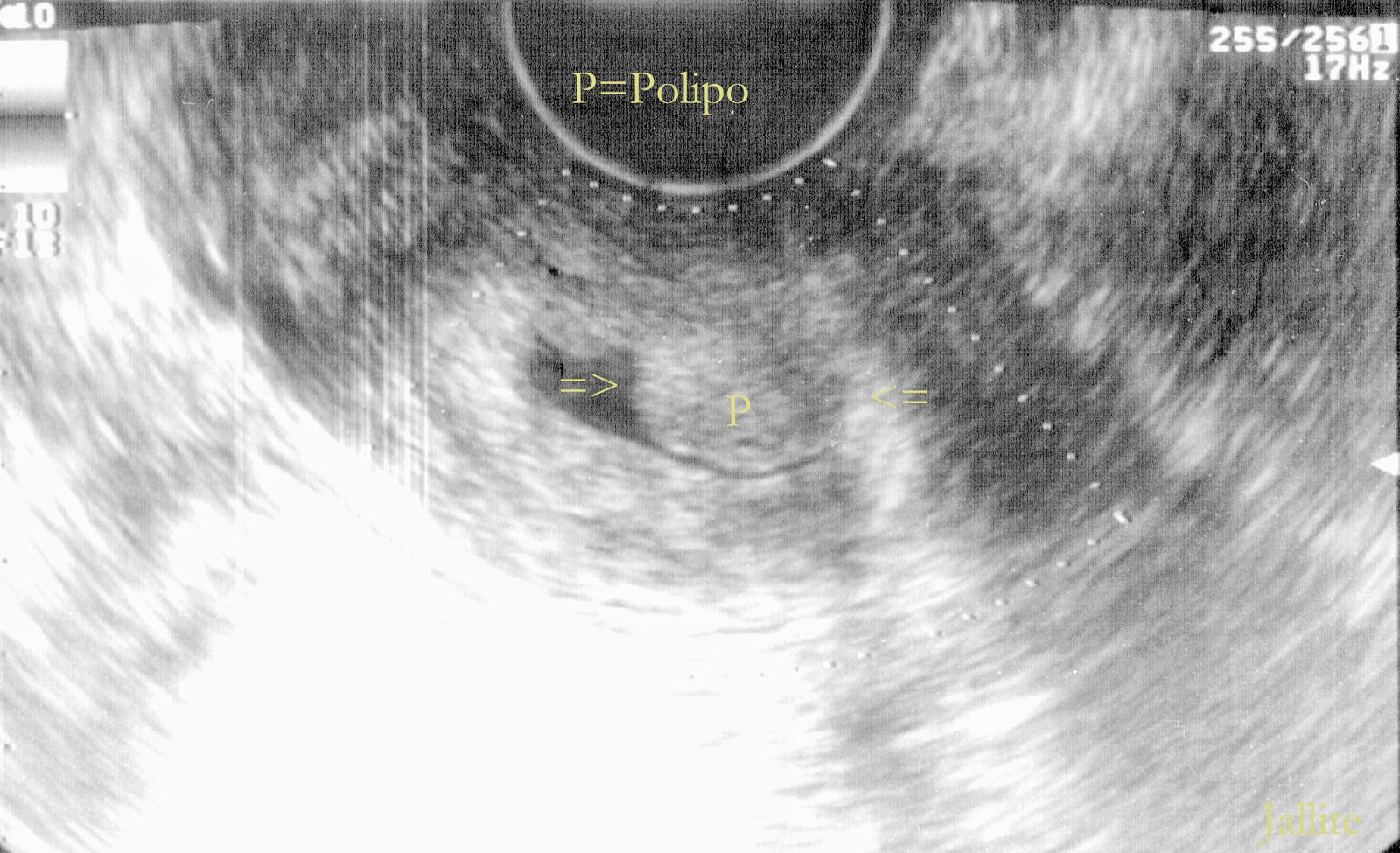 Presenza Della Componente Endocervicale Cosa Significa Polipo Endocervical
