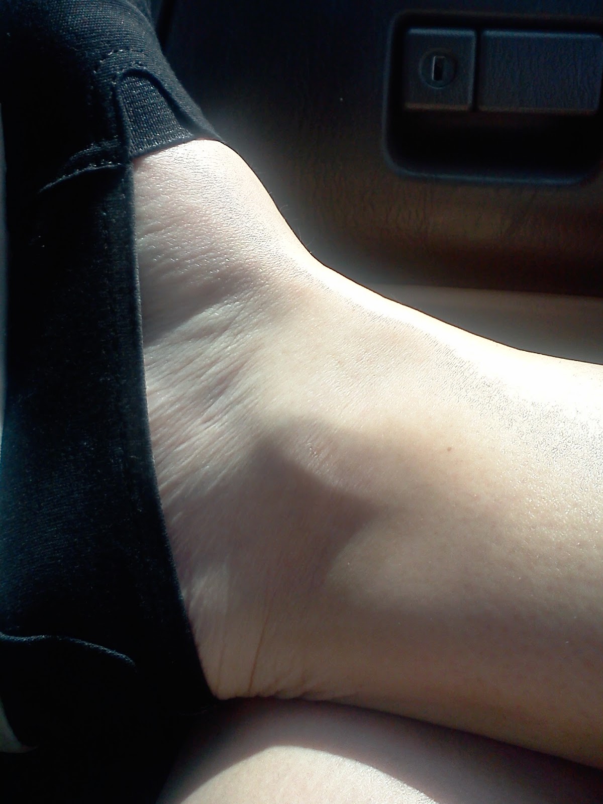 Life with Lupus: Swelling.....should I worry?