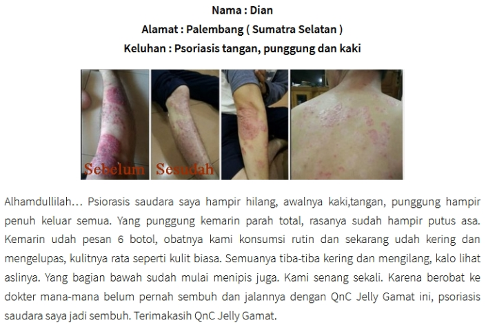 Cara Mengobati Kulit Gatal Disertai Memar atau Lebam Secara Alami ~ TESTIMONI QNC JELLY GAMAT Cara Mengobati Kulit Gatal Disertai Memar atau Lebam Secara Alami ~ TESTIMONI QNC JELLY GAMAT