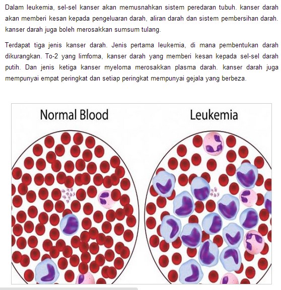 Awas Sila Sebarkan Info Ini Kenali Tanda Tanda Ini Di Tubuh Anda Sebelum Kanser Darah