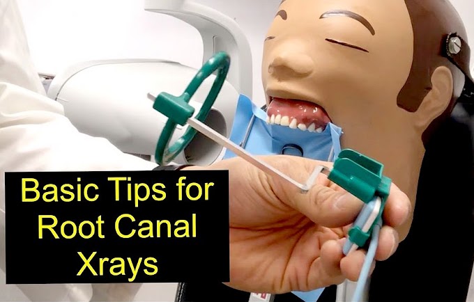 ENDODONTICS: Basic Tips for Root Canal Xrays