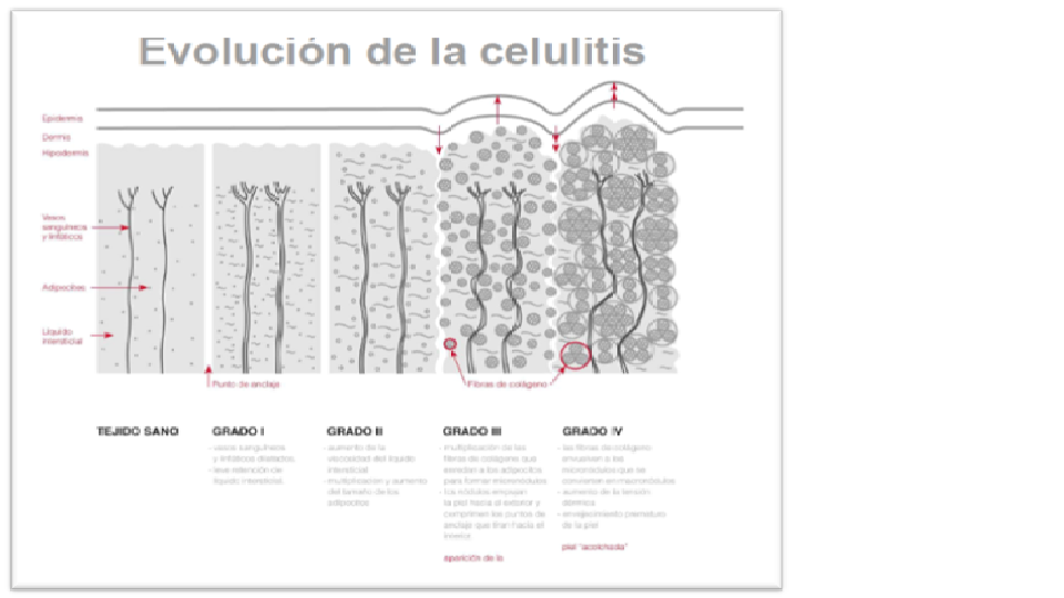 tipos de celulitis y su clasificacion tipos de celulitis y su clasificacion