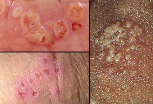 https://4.bp.blogspot.com/-oWpjUpVcQhQ/V9yD-gQychI/AAAAAAAAABw/SmG2FmFJsogvtI-o0zU7jfNTbttwh1VrACLcB/s1600/webmd_rm_photos_of_herpes_blisters.jpg