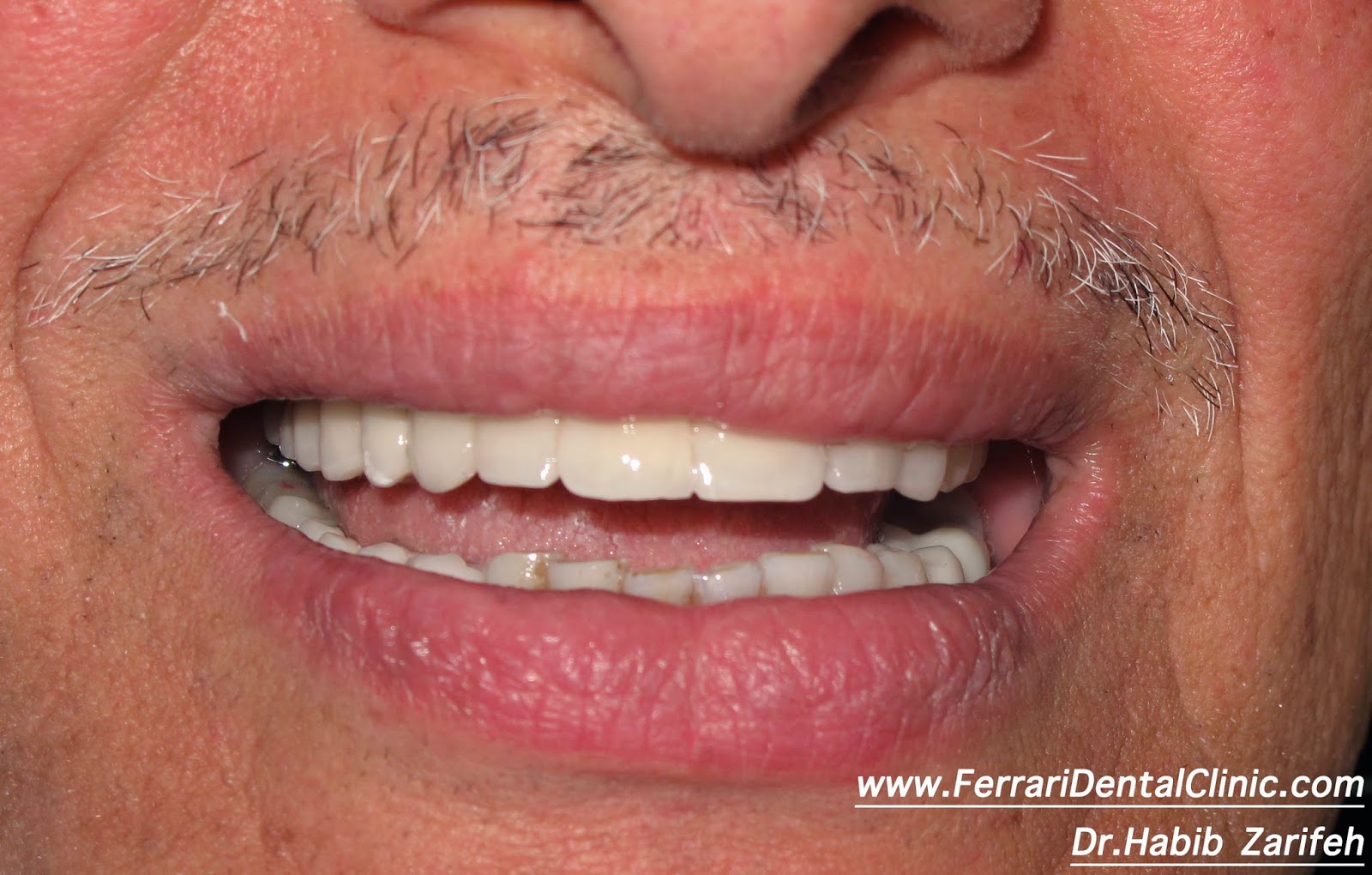 Dental implants Beirut Lebanon Elite dentist CMC Hospital