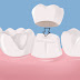 Độ bền răng sứ titan duy trì được bao lâu ?