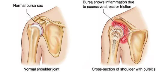 normal-shoulder-joint-and-inflammation