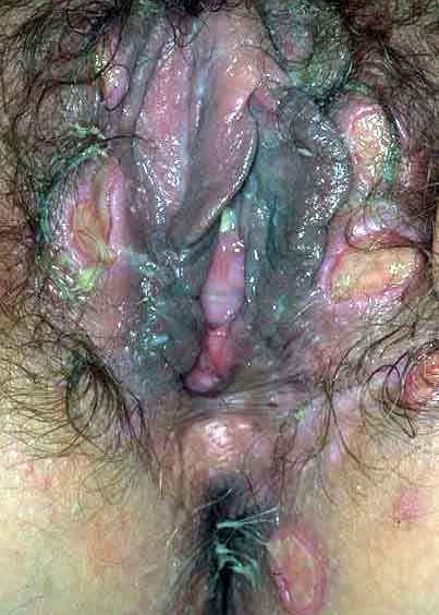 Male+Blue+Waffle+Pictures Below are the Images and Pictures of Blue Waffle that are worrying ...