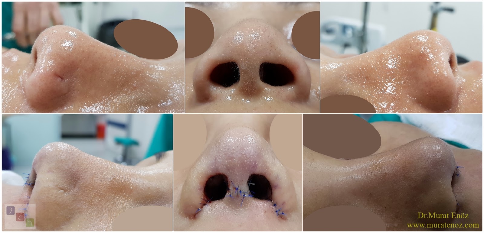 We Performed Tertiary Third Ethnic Revision Nose Aesthetic Surgery