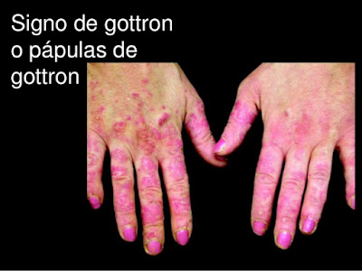 signo de gottron ?s