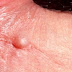 Lymphocele on Penile shaft & groin Pictures, Treatment, Diagnosis