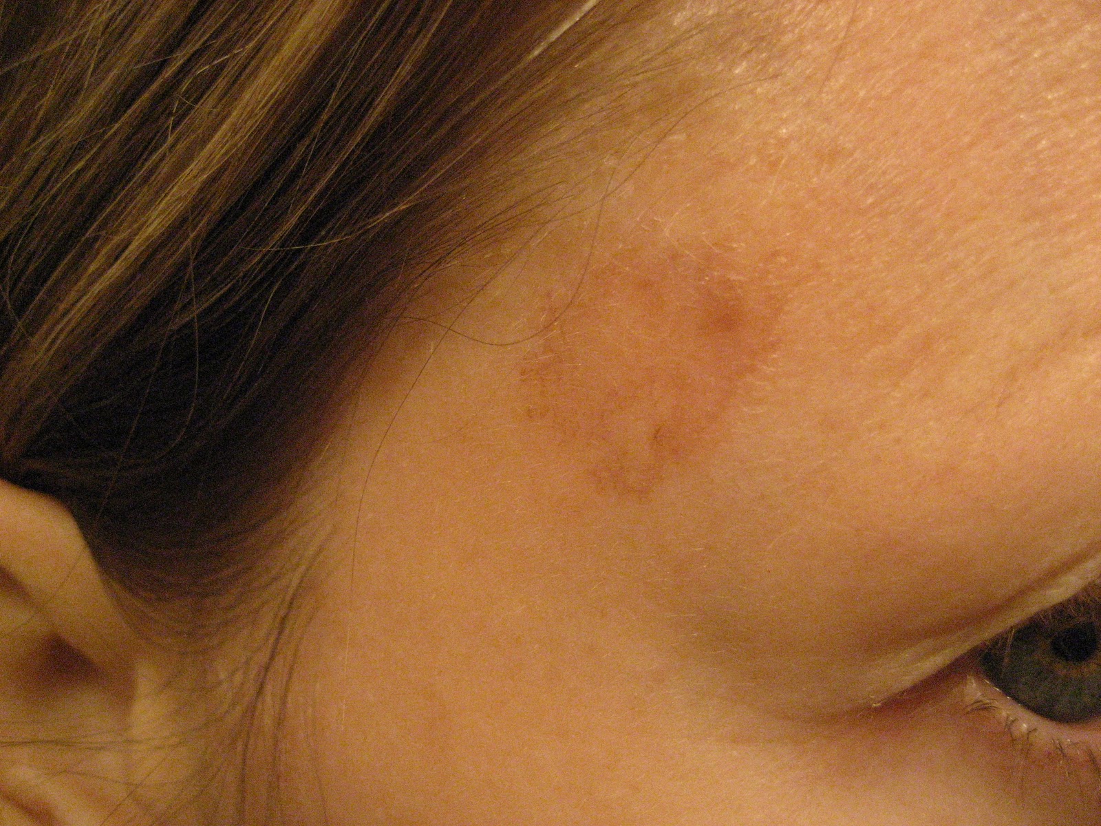 Chemical Peels For Acne And Anti Aging 18 Tca Chemical Peel Day 2