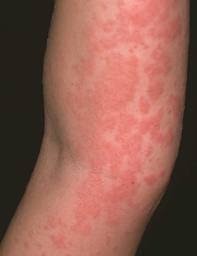 Piernas hinchadas con manchas rojas
