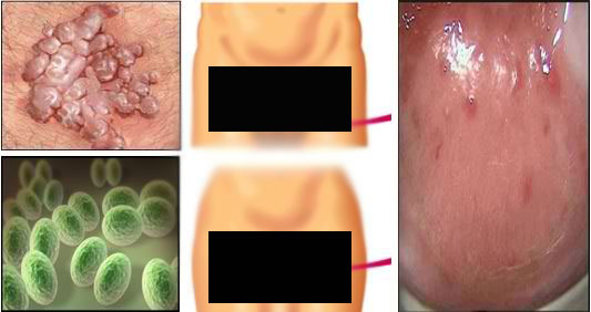 MUST READ: Hundreds Are Affected With This New Sexually Transmitted Infection! MUST READ: Hundreds Are Affected With This New Sexually Transmitted Infection!