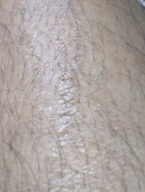 Clearer skin after 35% TCA Peel