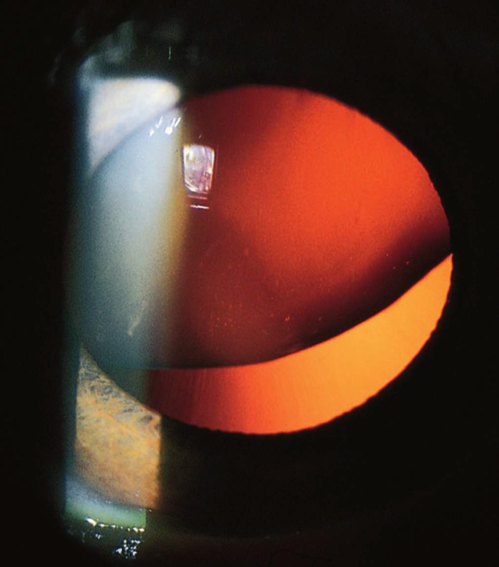 Study Medical Photos Lens Dislocation