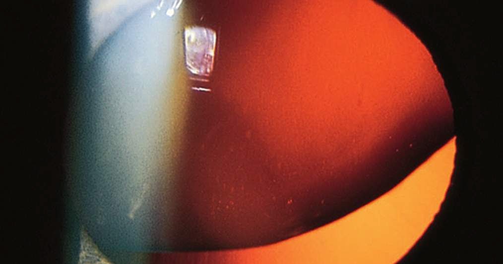 Study Medical Photos Lens Dislocation