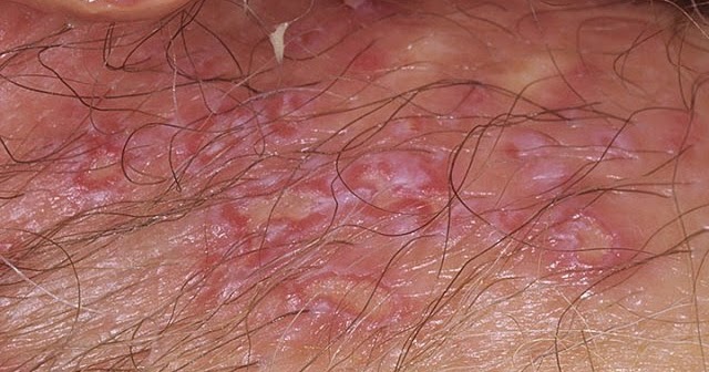 Herpes outbreaks on your hand? - H Opp Forums