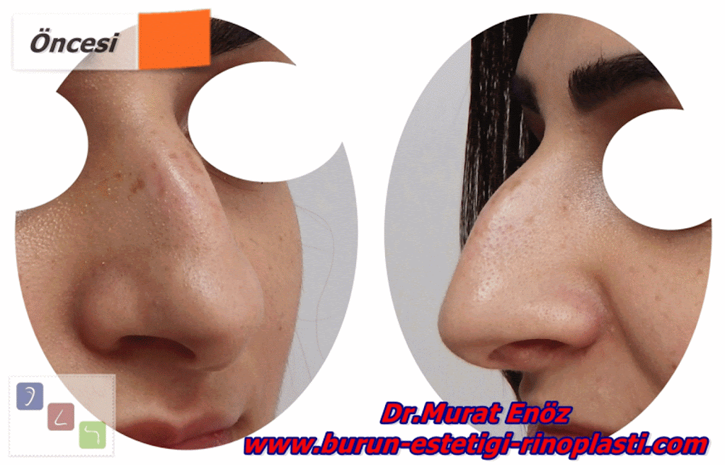 Burun Eti Büyümesi (Konka Hipertrofisi)