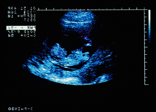 datovania ultrazvuk pohlavia