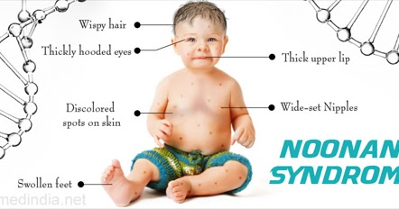 The Noonan Syndrome Characteristics You Must Know