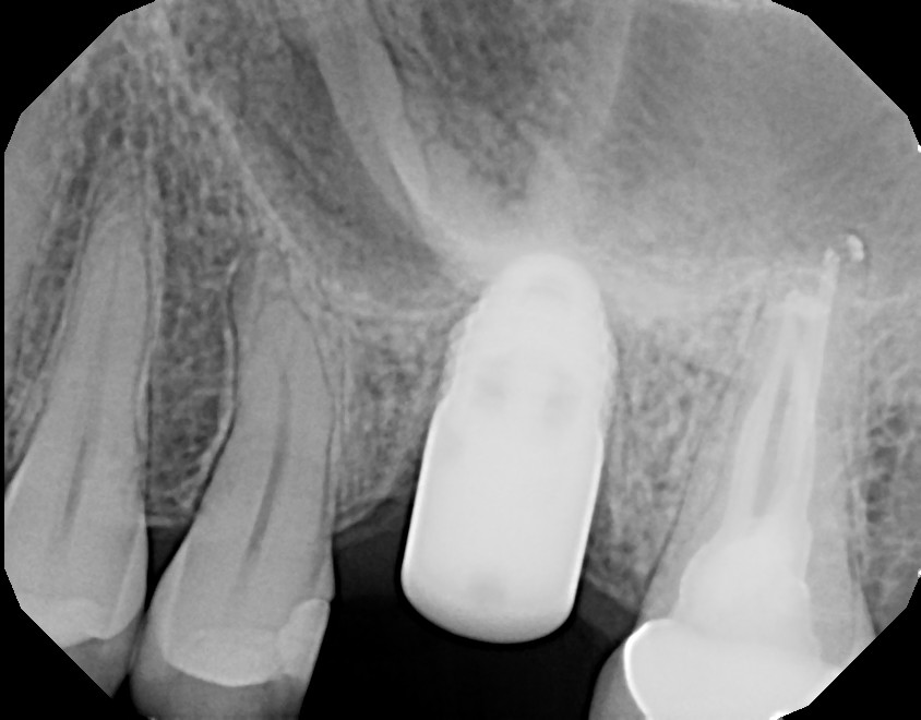 Blog Tooth still hurts AFTER root canal and