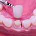 Bạn biết gì về phục hình răng sứ?
