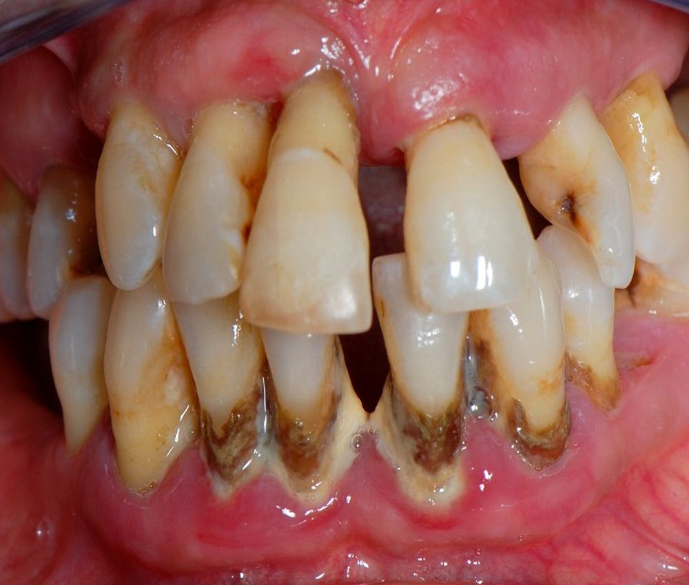 periodontitis-agresiva