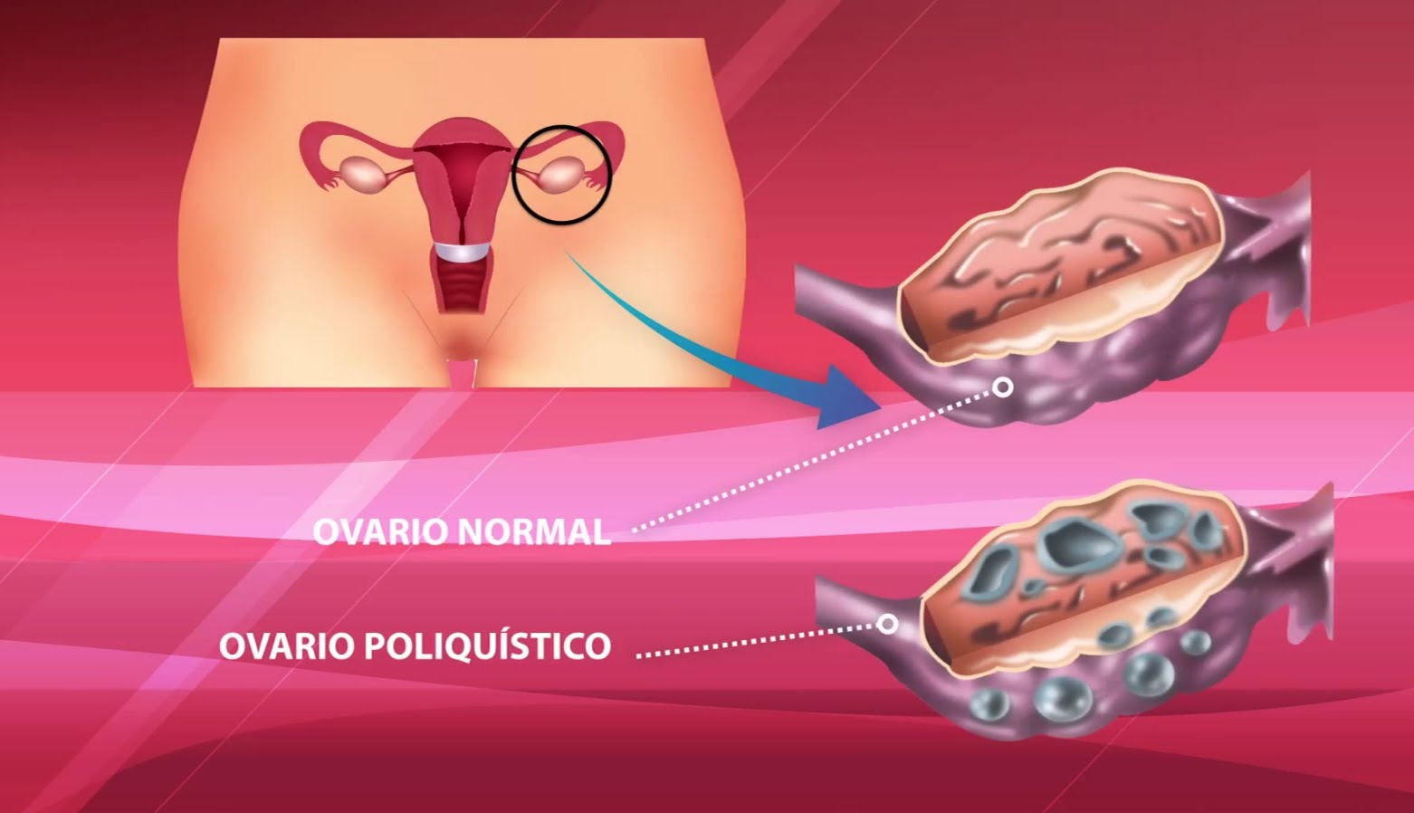 Dr. Síndrome de Ovarios Poliquísticos Managua