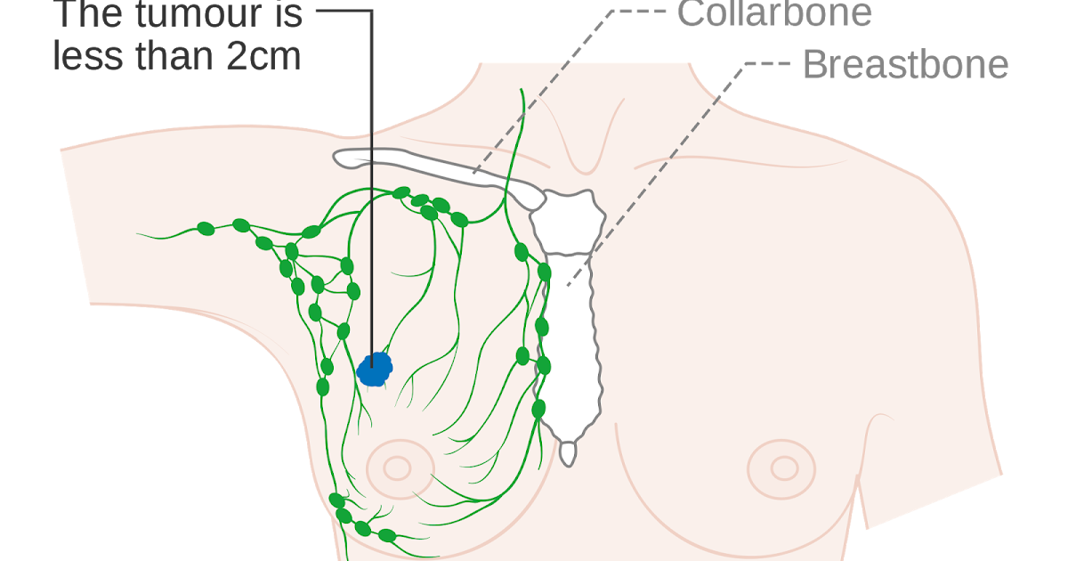 топография молочной железы, лимфоотток. лимфоузлы млоочно йжелезхы. лимфоузлы грудной клетки. отток лимы от молочной желен. подмышечные лимфатические узлы на теле человека схема.