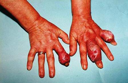 Totul despre artrita genunchiului - Simptome, tipuri, tratament | bekkolektiv.com