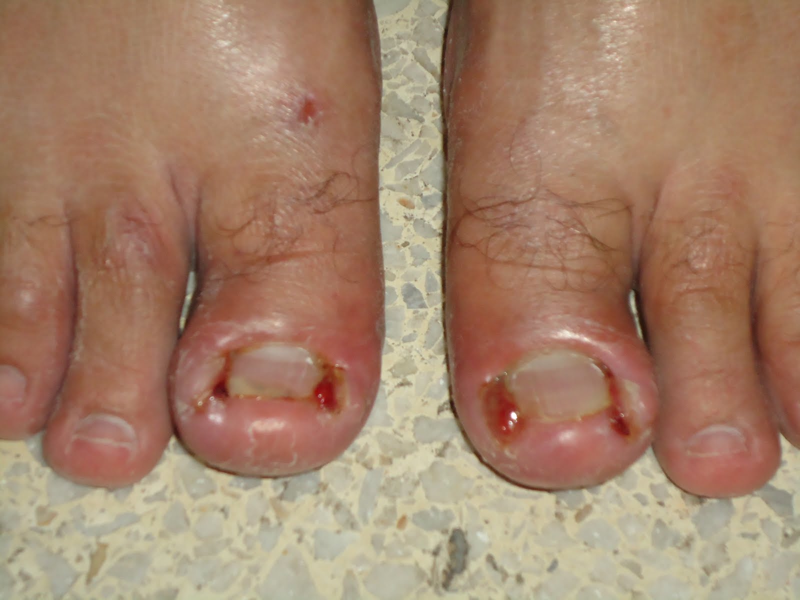 Dedo Gordo Principio De Hongos En Las Uñas