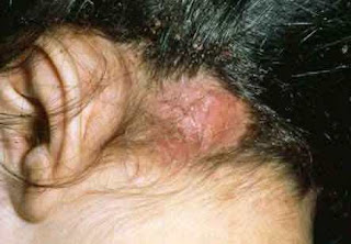 abscesses of the head