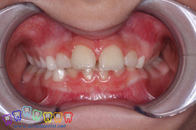 diastema tedavisi - ortodontist - dişler arası boşluk tedavisi