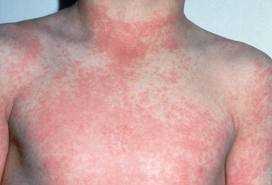 streptococcal infection rash