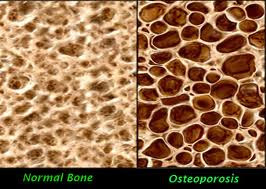 Cara Mencegah Osteoporosis