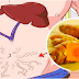 Fatty Liver Disease: Best Natural Remedies For Treating Fatty Liver