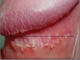 Gejala Hpv