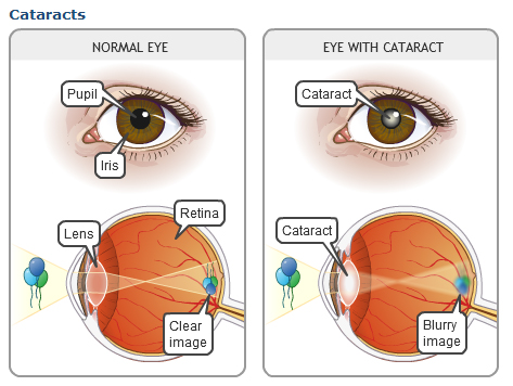 How to eliminate cataracts with natural remedies