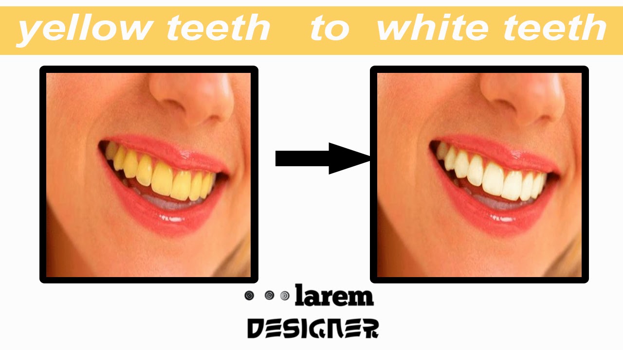 How to change Yellow teeth to white teeth Larem Designer