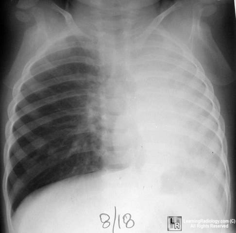 atelectasis lung collapse ray effusion chest pneumonia radiology partial breathing tumblr diagnosing identifying acquainting investigation radiographic via hemithorax insights bds