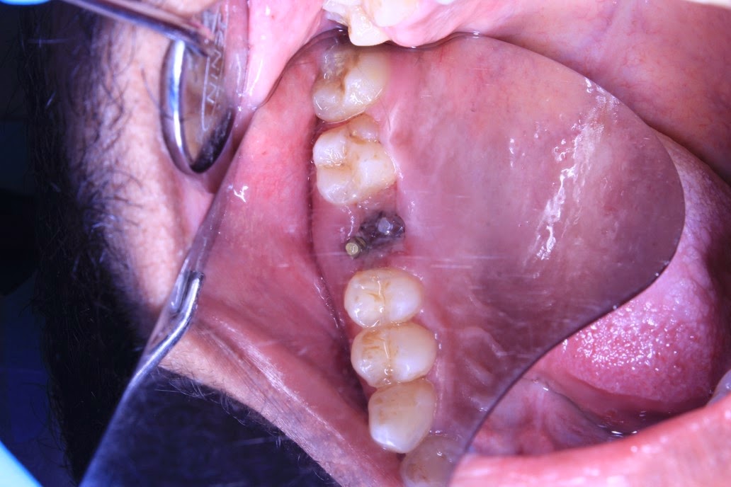 Upper decayed molar extraction and implant placement