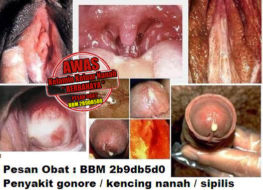 Cara Pengobatan Kencing Nanah Dengan Kapsul Antibiotik Cara Pengobatan Kencing Nanah Dengan Kapsul Antibiotik