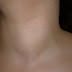Maladie de la thyroïde : goitre glande thyroïde gonflée