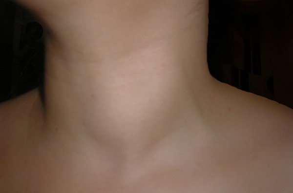 Maladie de la thyroïde : goitre glande thyroïde gonflée