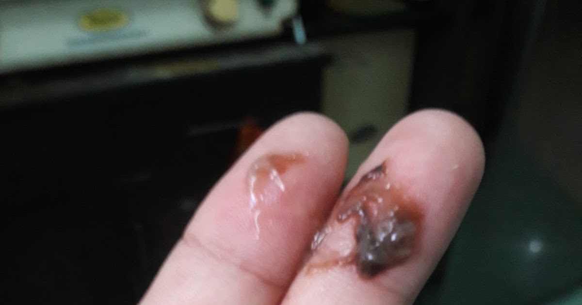 Keluar Lendir Coklat Setelah Haid Informasi Dunia Kesehatan