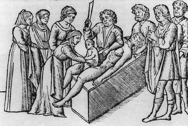 Resiko Tinggi dan Efek Samping Melakukan Operasi Sesar, Nyawa Jadi Taruhan