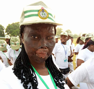 Photos: "My own WCW" - Brave burn survivor who was attacked with acid by uncle