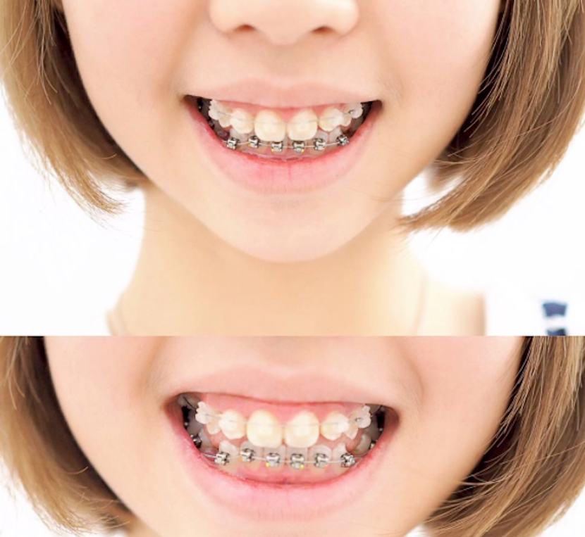 Braces On Bottom Teeth Only Cost TeethWalls