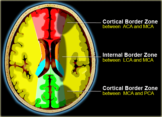 Watershed Infarction Definition of Watershed Infarction