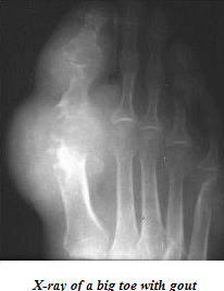 Mycare Health products: Relieve Your Gout Using Safe, Proven ...